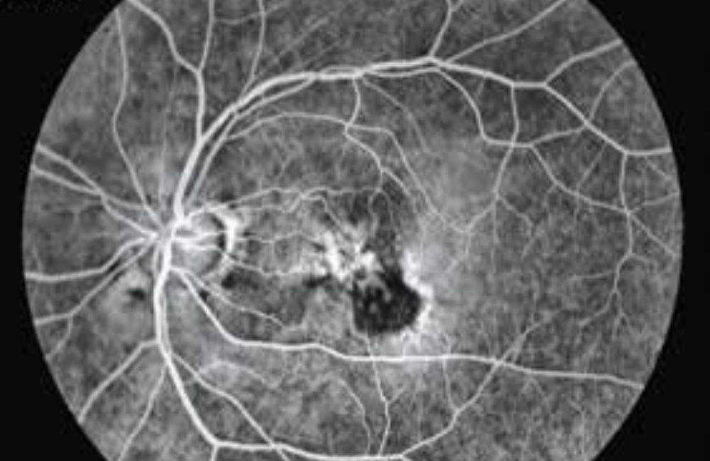 What is Age-related macular degeneration?