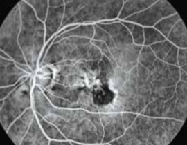 What is the difference between dry and wet age-related macular degeneration