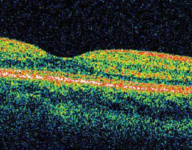 Understanding the treatments for dry macular degeneration