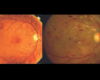 What is Diabetic Retinopathy?