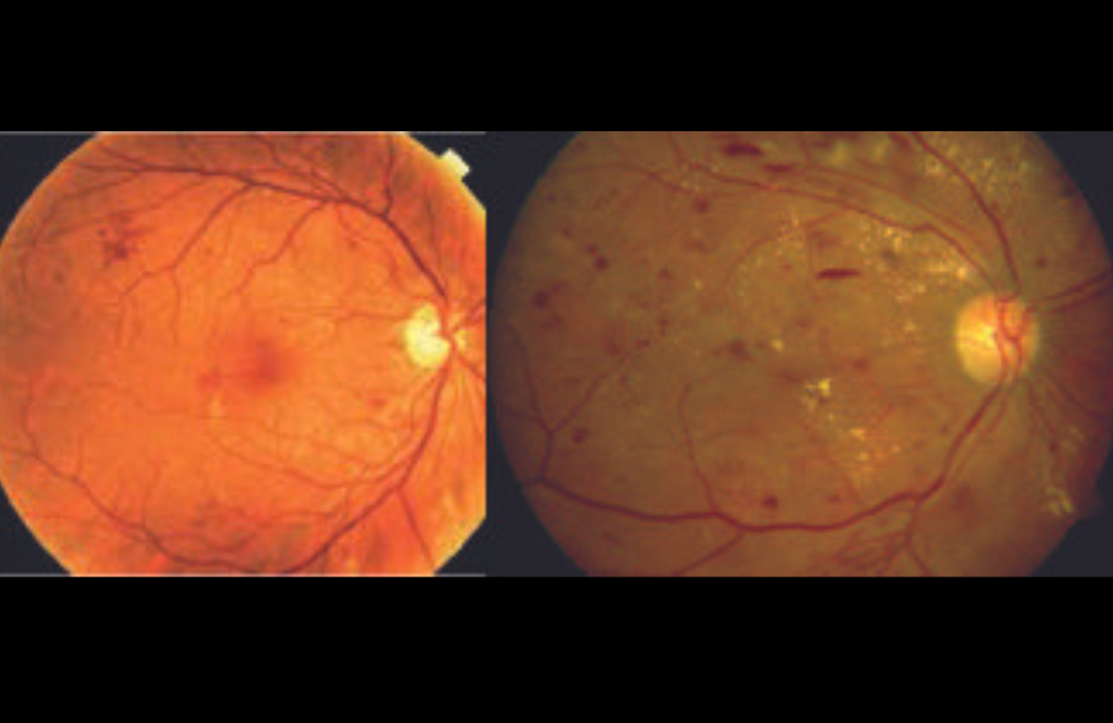 What is Diabetic Retinopathy?