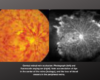 What is a Retinal Vein Occlusion (RVO)?