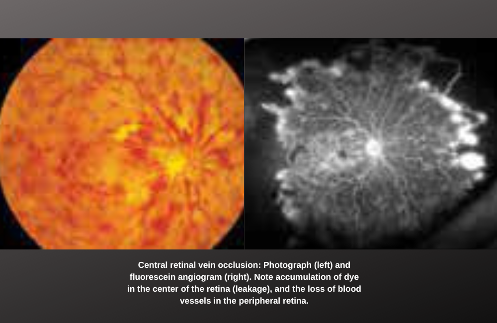 What is a Retinal Vein Occlusion (RVO)?