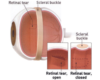 What are Treatments for a Retinal Tear?