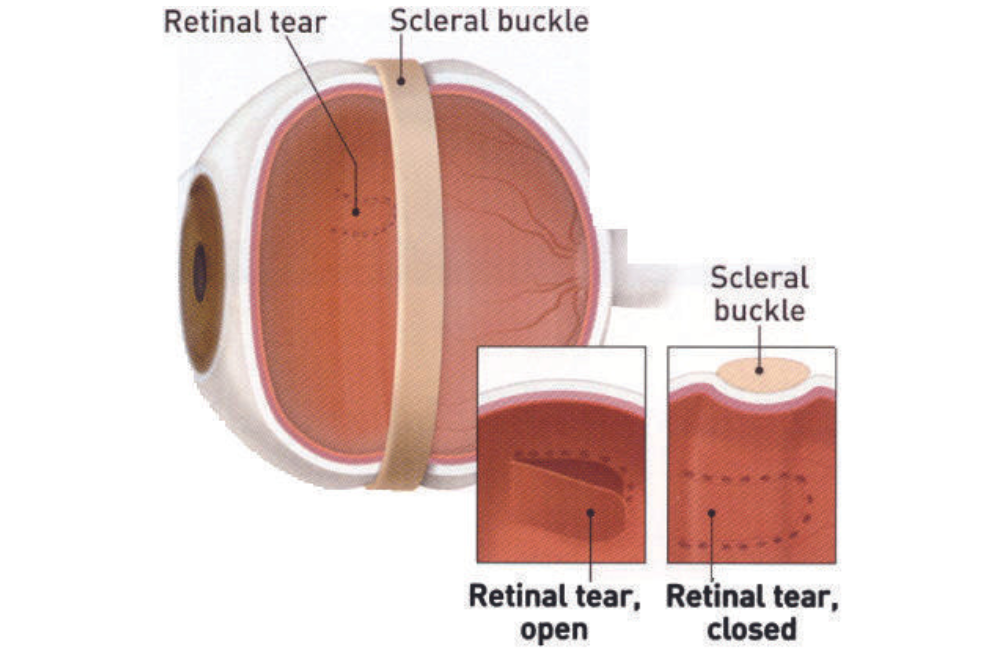 What are Treatments for a Retinal Tear?